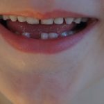 Milchzähne Zahnprophylaxe