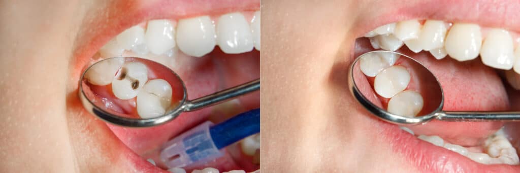 Zahnfüllungen sorgen für eine funktionale und ästhetische Zahnwiederherstellung und sind eine bewährte Methode in der Zahnmedizin.