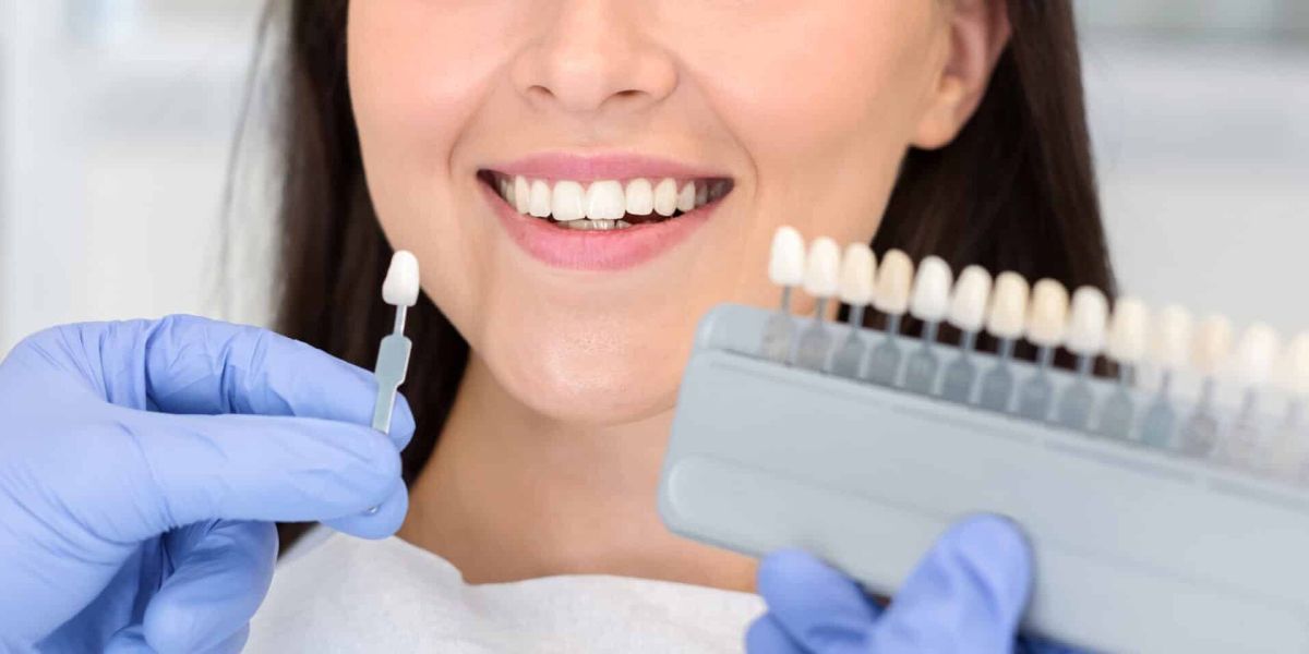 Ihr umfassender Ratgeber zum Thema Bleaching