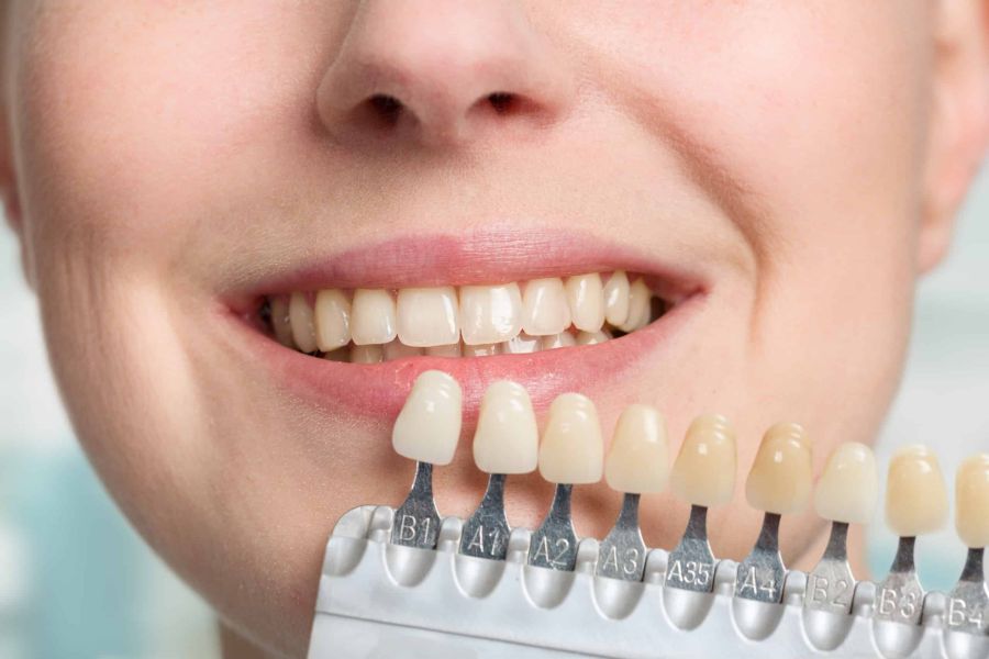 Bleaching ist eine beliebte Methode in der ästehetischen zahnmedizin, um Ihre Zähne sichtbar aufzuhellen und Ihnen ein strahlendes Lächeln zu ermöglichen.