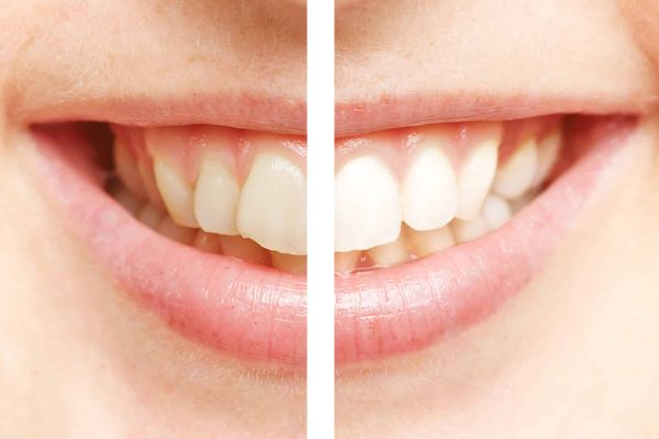 Professionelle Zahnreinigung – Was wird gemacht?